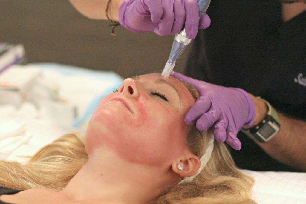 SkinPen Microneedling