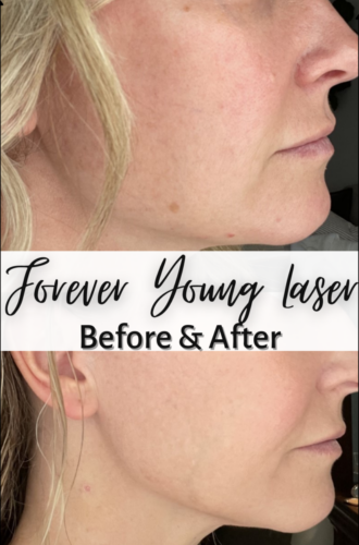Beauty: Forever Young Laser Before And After Results