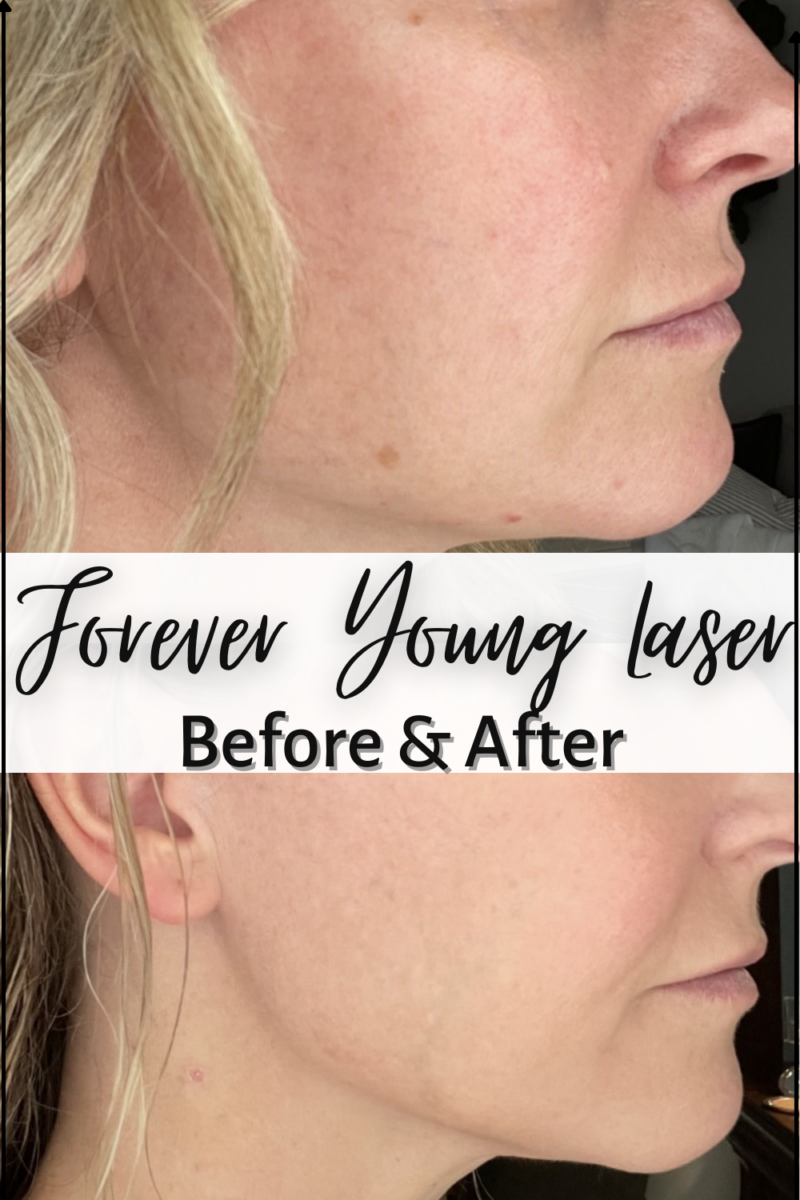 Forever Young Laser Before And After Results featured by top Houston beauty blogger, Haute & Humid